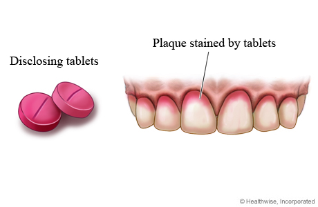 Disclosing tablets and stained plaque on teeth