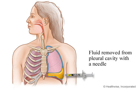 Placement of a thoracentesis needle