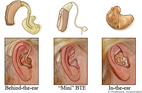 Styles of hearing aids