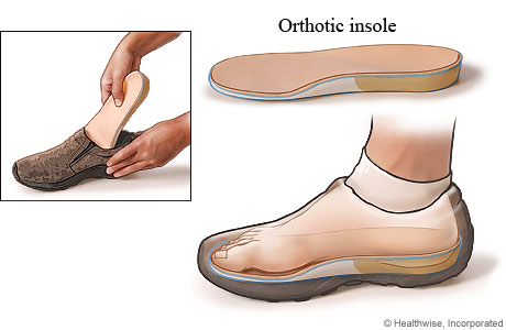 How to use an orthotic insole