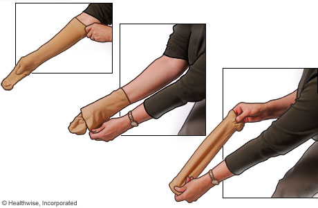 Picture of how to put on compression stockings: Step 2