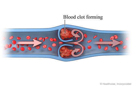 Blood clot forming