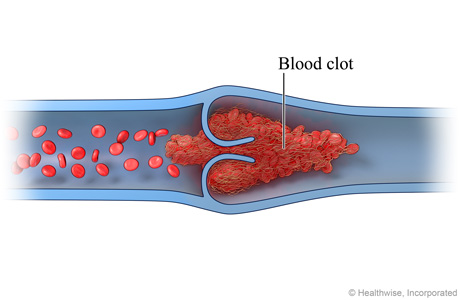 Cross section of a vein, showing blood clot formed around valve