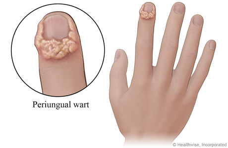 Periungual wart on finger