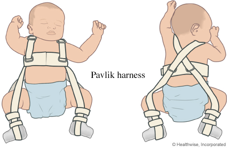 Picture of a Pavlik harness on a baby