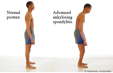 Normal posture compared to the posture of advanced ankylosing spondylitis