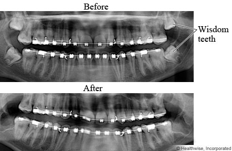 X-rays of teeth before and after wisdom teeth removal
