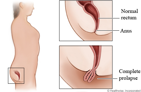 Normal rectum and complete prolapse of rectum