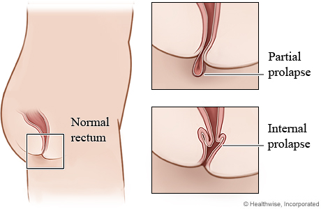 Rectal prolapse: partial and internal