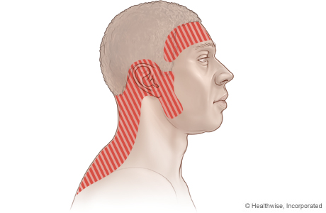 Picture of possible areas of pain with tension headache