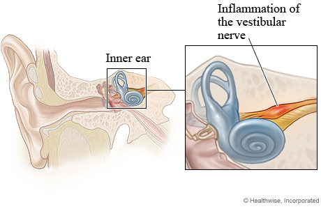 Vestibular neuritis