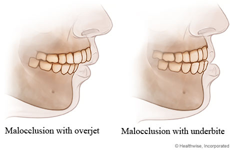 Malocclusion with overjet and with underbite