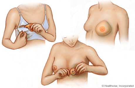 Three types of breast forms