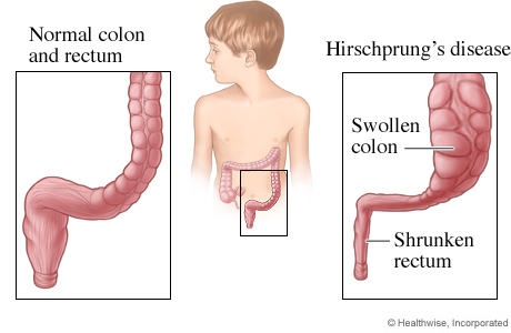 Picture of Hirschsprung's disease