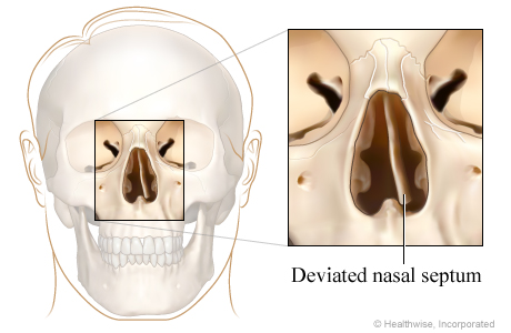 Deviated nasal septum