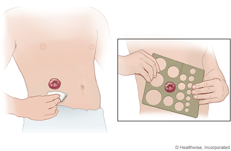 Cleaning your skin and measuring your stoma