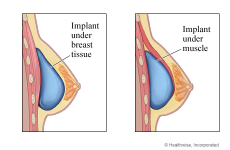 Breast implant under breast tissue and implant under muscle