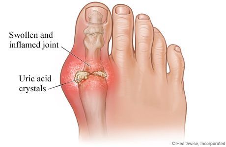 Picture of gout in the big toe