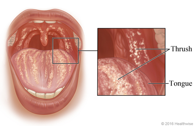 Thrush in the mouth, with close-up of thrush on tongue and inside of cheek