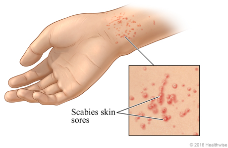 Scabies rash on a wrist, with close-up of typical sores