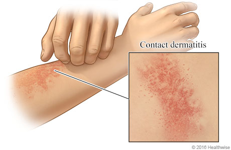 Contact dermatitis on an arm, with close-up of rash
