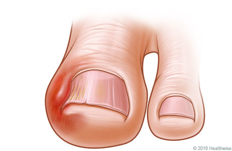 Dedo gordo del pie con uña encarnada, donde se aprecia el enrojecimiento y la hinchazón