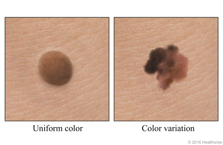A mole of uniform color and a mole showing color variation