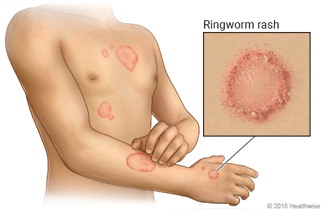Ringworm skin rash on arm and chest, with a close-up of rash