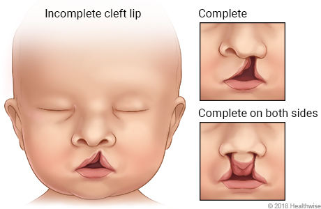 Faces of babies, showing three kinds of cleft lip: incomplete, complete, and complete on both sides