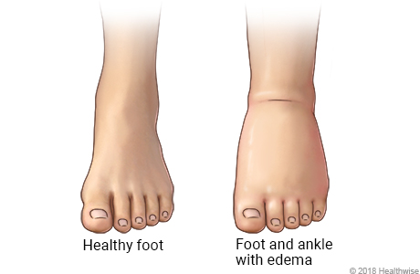Normal foot and ankle, and foot and ankle with edema