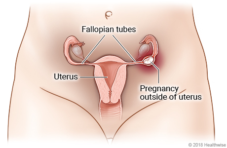 Female reproductive system, showing pregnancy outside uterus in fallopian tube