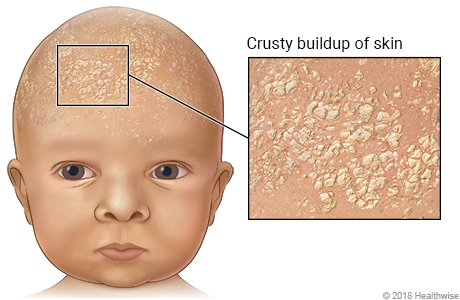 Cradle cap on baby's scalp, with close-up of oily, crusty buildup of skin