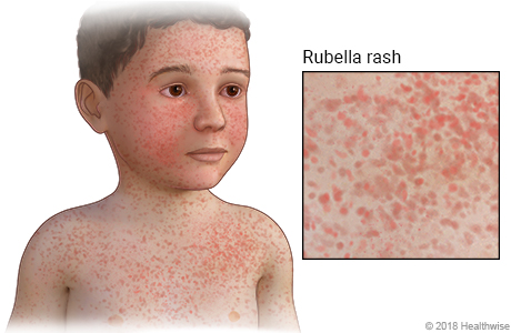 Child with rash caused by rubella on face, neck, and chest, with close-up of rash