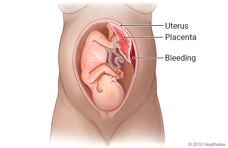 Baby in uterus, showing placenta separated from wall of uterus and bleeding