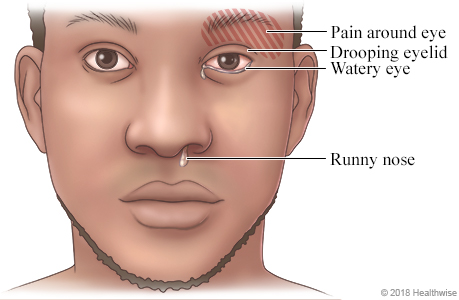 Face of person showing symptoms of a cluster headache