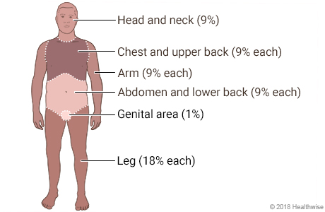 Body divided into areas showing percentages of surface area