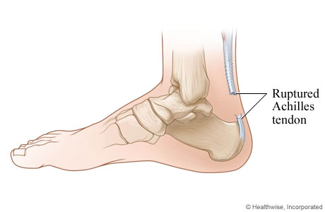 Ruptured Achilles tendon