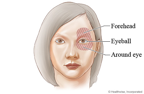 Picture of the areas of pain from closed-angle glaucoma
