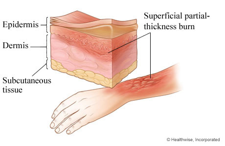 Second-degree burn: superficial partial-thickness burn