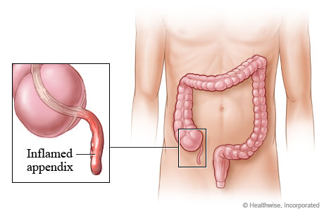 Appendicitis and where the appendix is located in the body