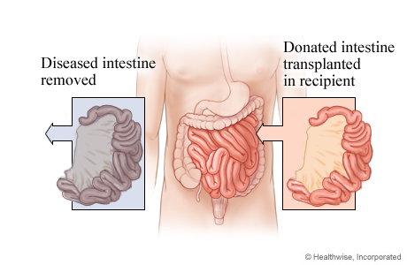 Picture of intestinal transplant