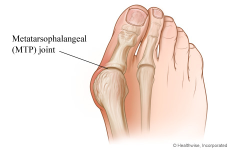 Picture of a bunion and the joint at the base of the big toe