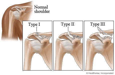 Type I, type II, and type III shoulder separation injuries
