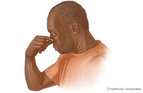 Man pinching his nose to stop a nosebleed