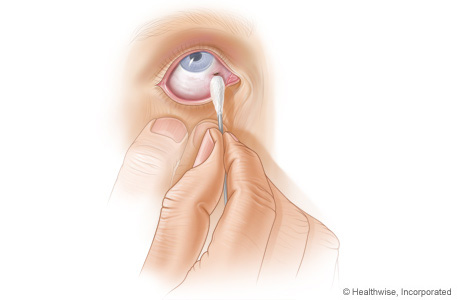 How to remove an object from the eye