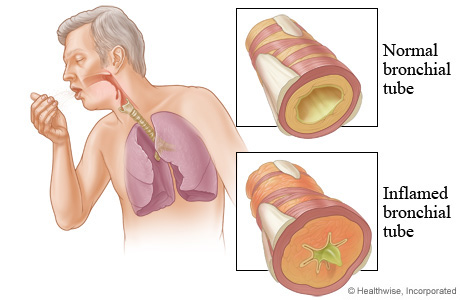 An inflamed bronchial tube from acute bronchitis