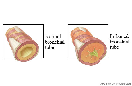 Normal and inflamed bronchial tubes