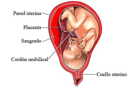 Imagen de desprendimiento prematuro de placenta