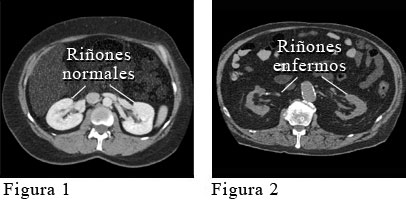 Tomografía computarizada que muestra riñones normales y riñones dañados