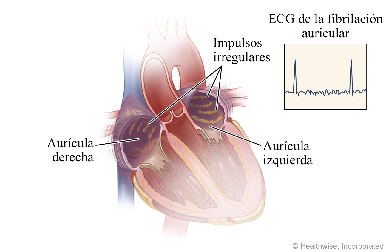 Impulsos irregulares en el corazón durante la fibrilación auricular, y un ECG con un resultado anormal